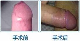 包皮过长6大危害?