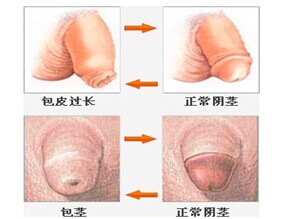 包皮过长6大危害?